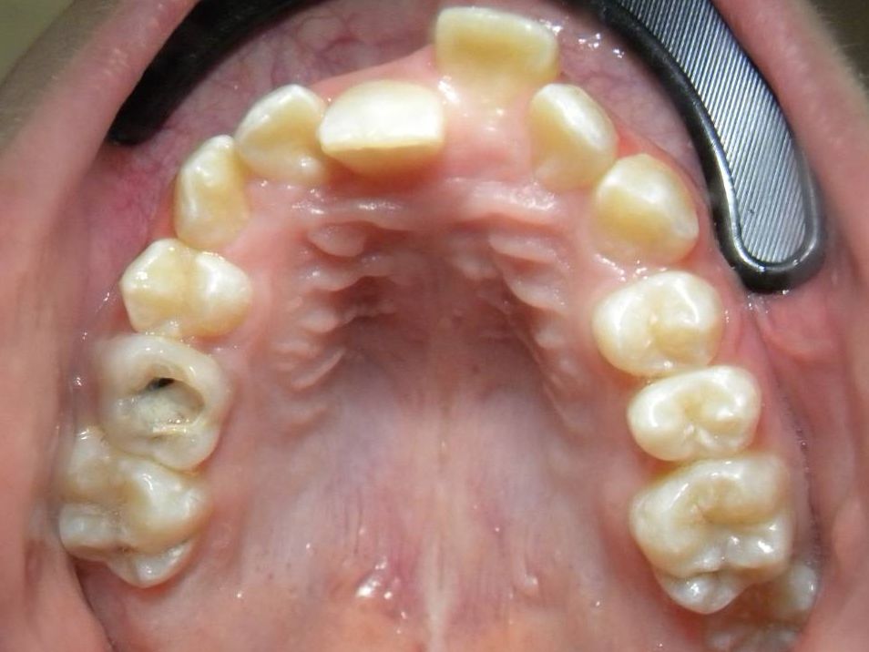 Oclusal Superior