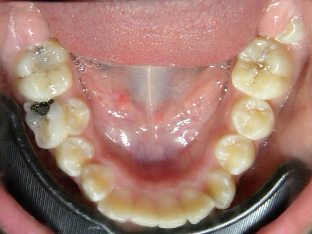Oclusal Inferior
