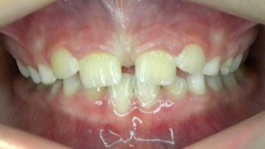 Frontal (Oclusión)