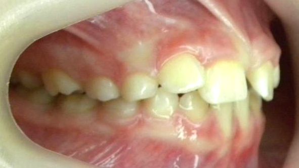 Lateral Derecha