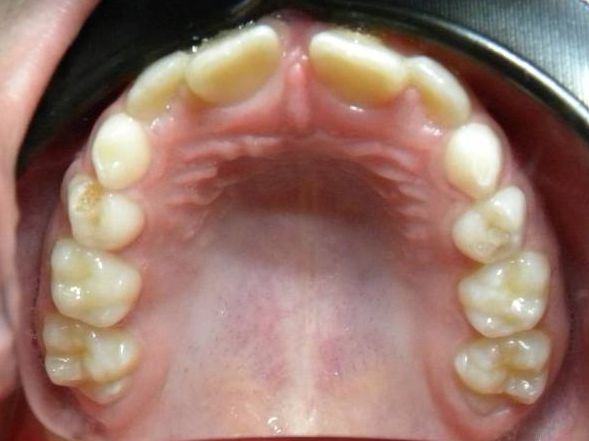 Oclusal Superior