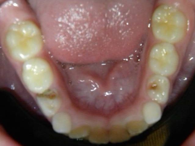 Oclusal Inferior