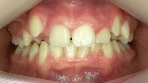 Frontal (Oclusión)
