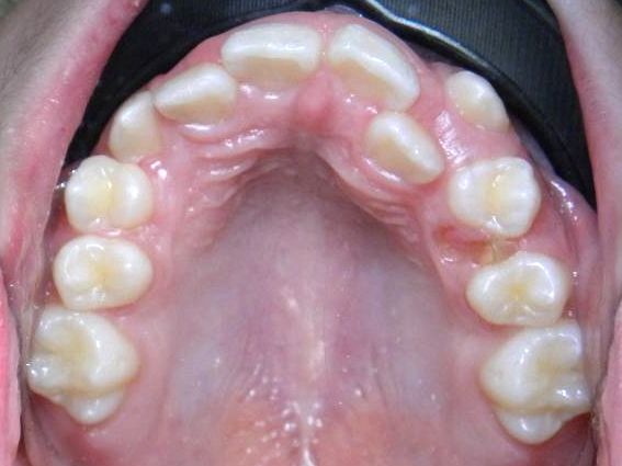 Oclusal Superior