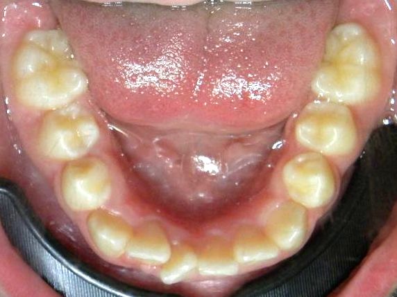 Oclusal Inferior