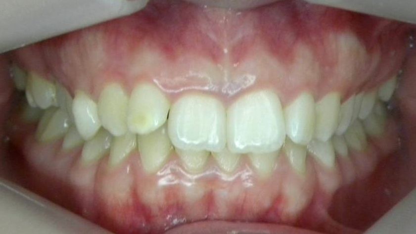 Frontal (Oclusión)