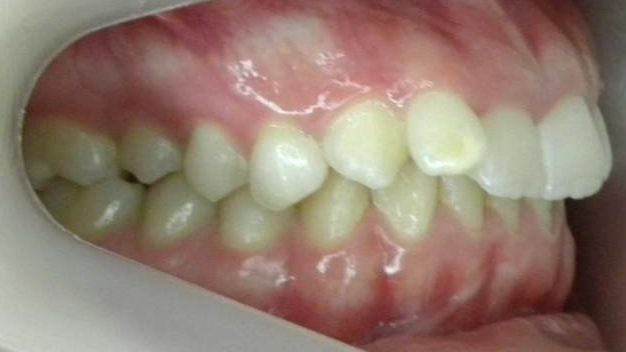 Lateral Derecha
