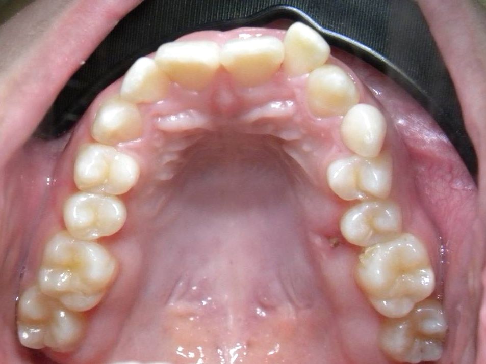 Oclusal Superior