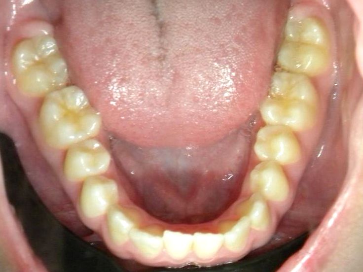 Oclusal Inferior