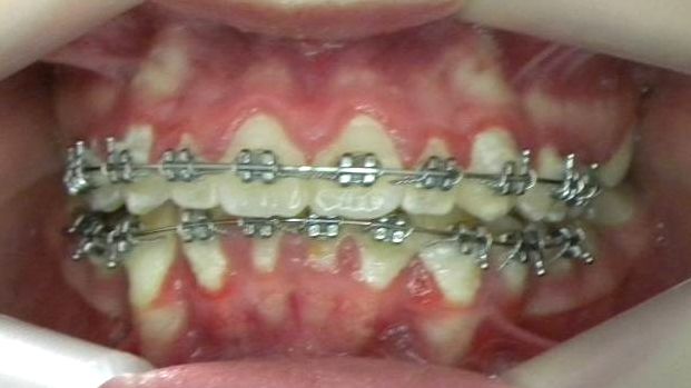 Frontal (Oclusión)