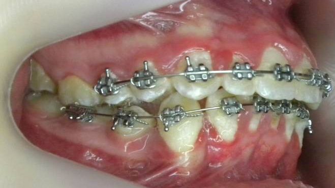 Lateral Derecha