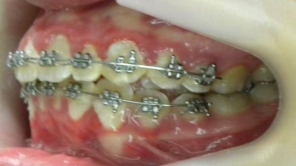Lateral Izquierda