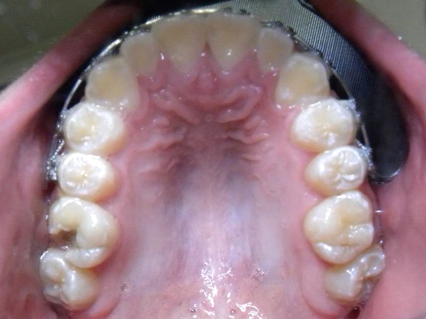 Oclusal Superior