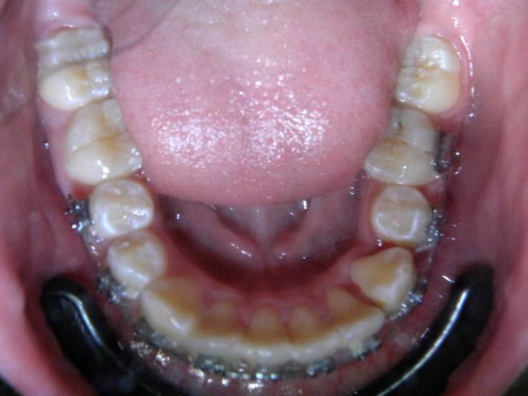 Oclusal Inferior