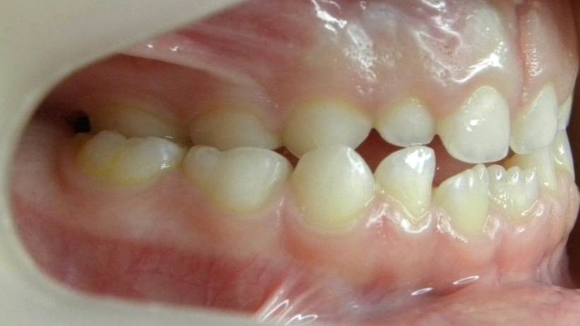 Lateral Derecha
