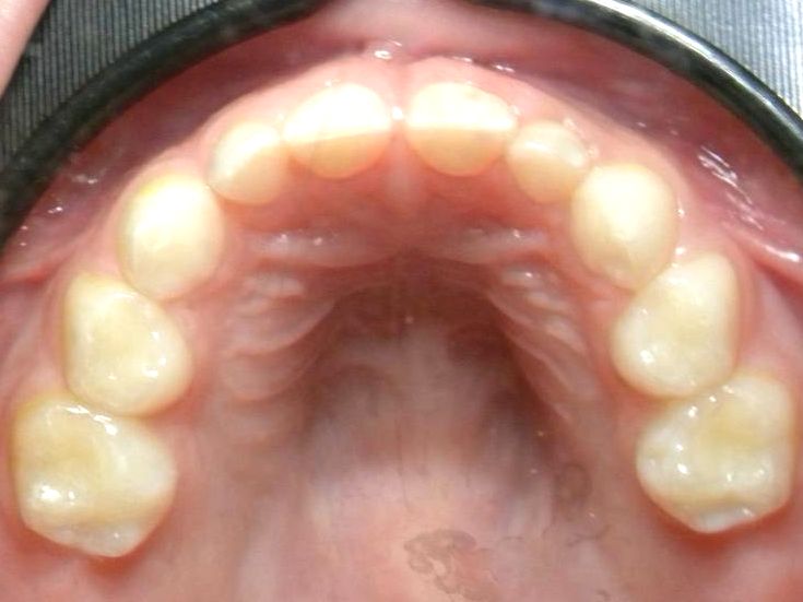 Oclusal Superior