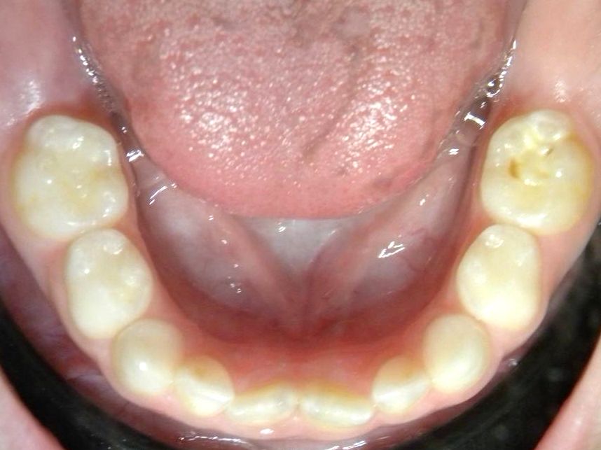 Oclusal Inferior