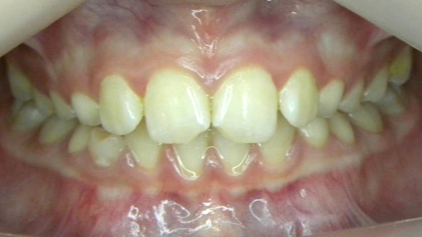 Frontal (Oclusión)