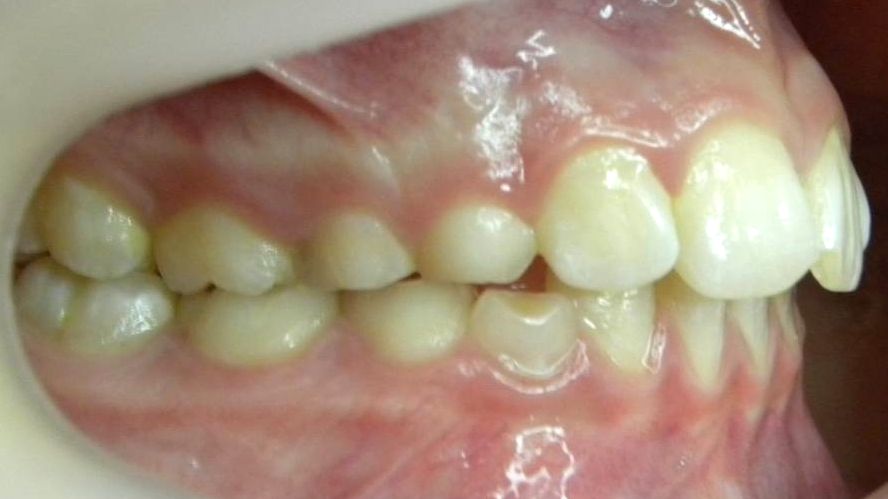 Lateral Derecha