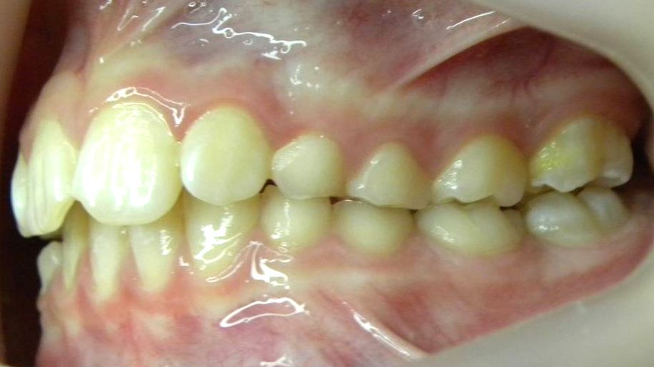 Lateral Izquierda