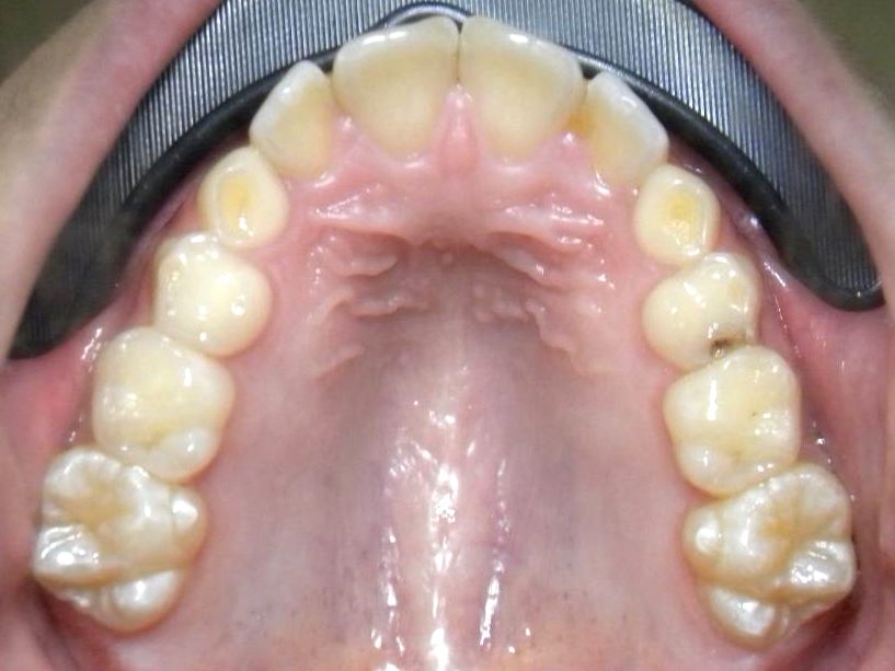Oclusal Superior