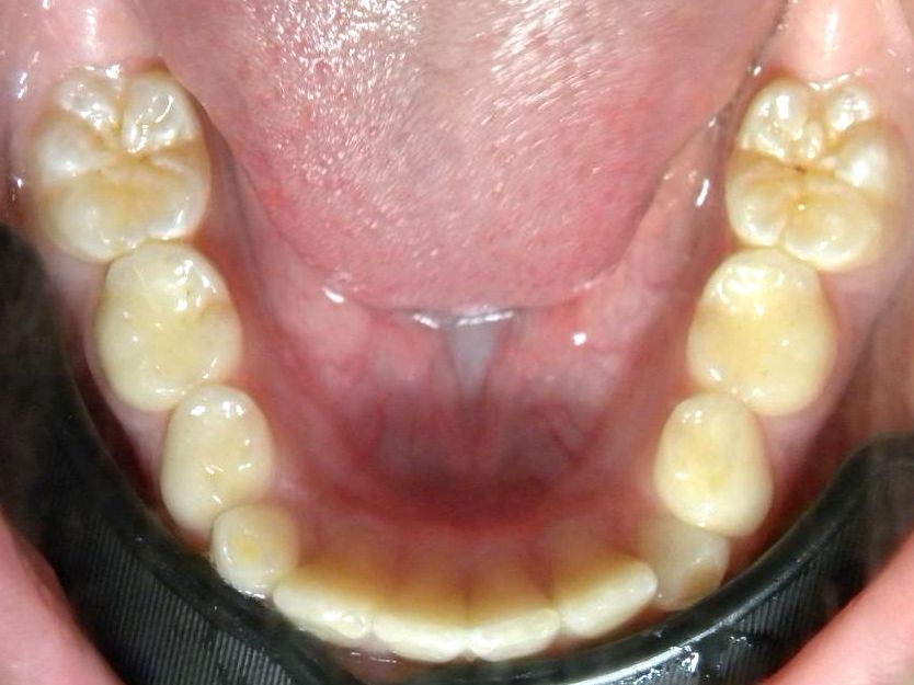 Oclusal Inferior