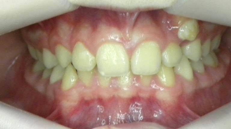 Frontal (Oclusión)