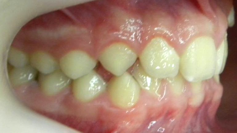 Lateral Derecha