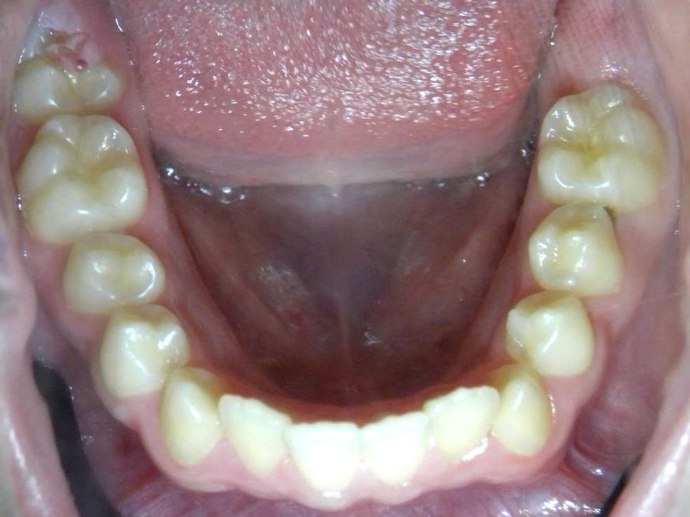 Oclusal Superior