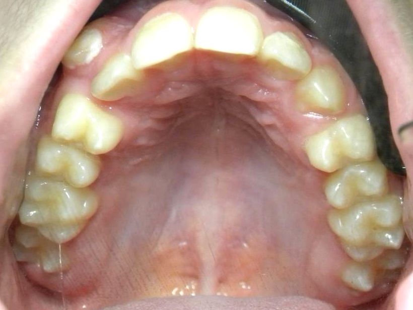 Oclusal Inferior