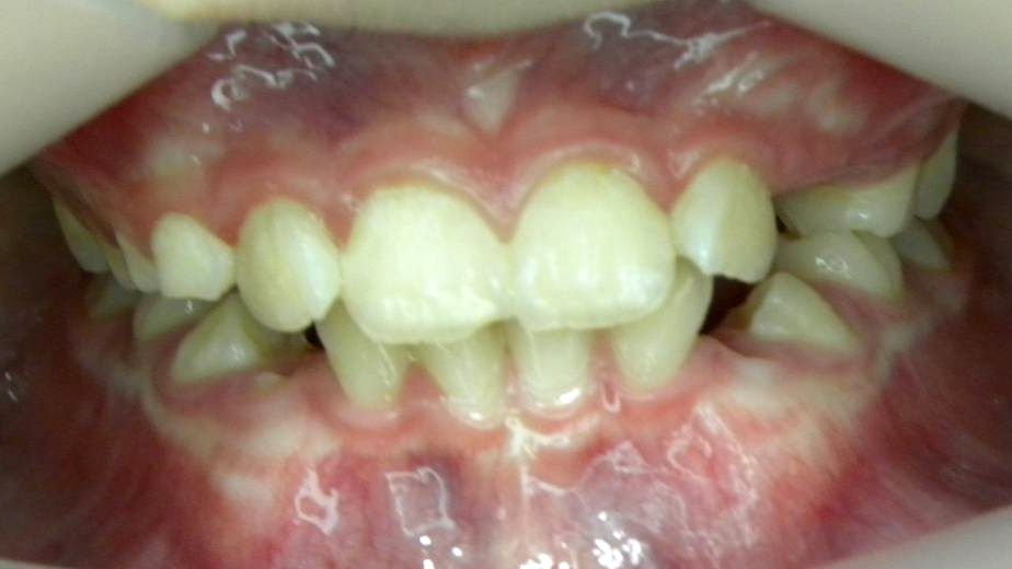Frontal (Oclusión)