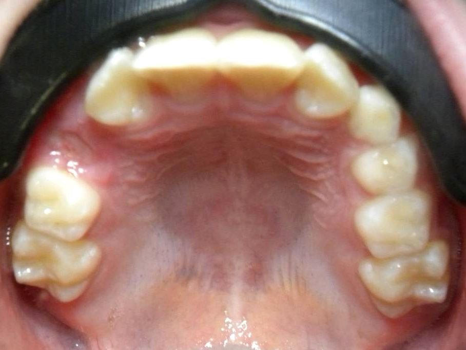 Oclusal Superior