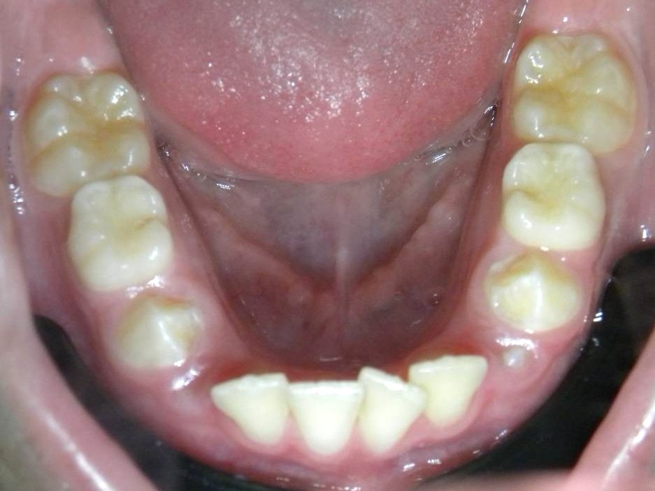 Oclusal Inferior