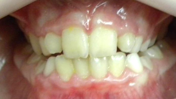 Frontal (Oclusión)