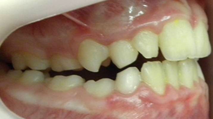 Lateral Derecha
