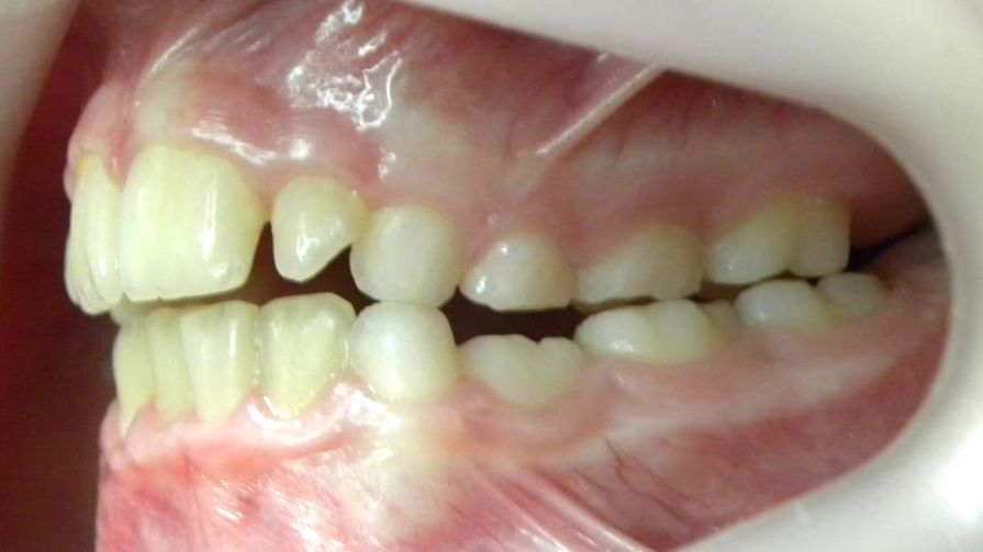 Lateral Izquierda