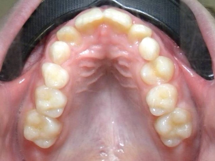 Oclusal Superior
