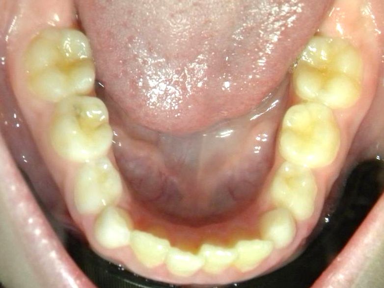 Oclusal Inferior