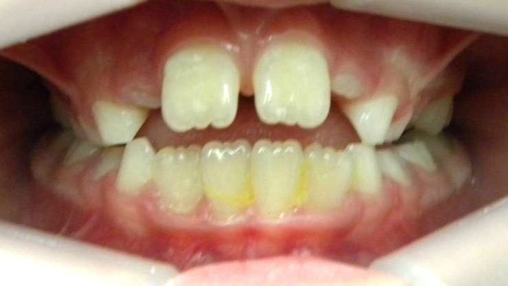 Frontal (Oclusión)