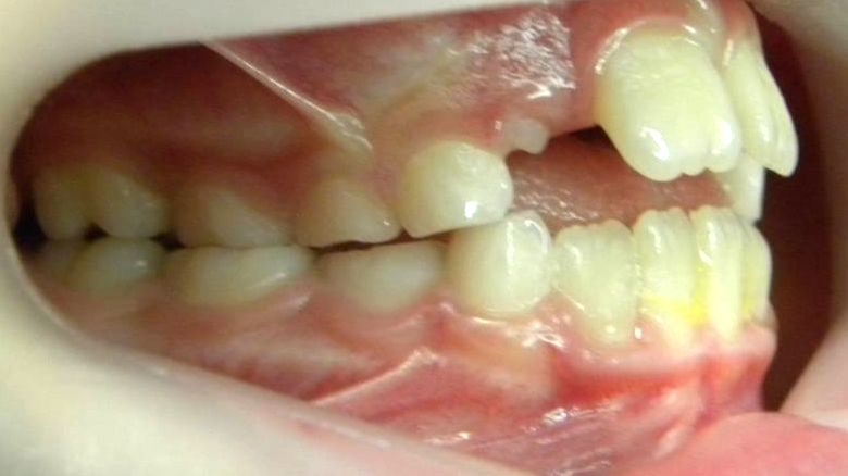 Lateral Derecha