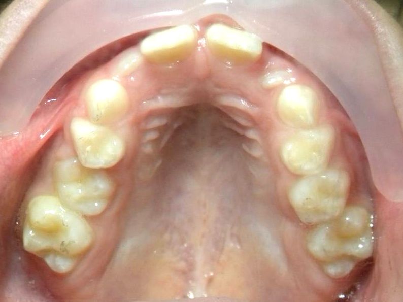 Oclusal Superior