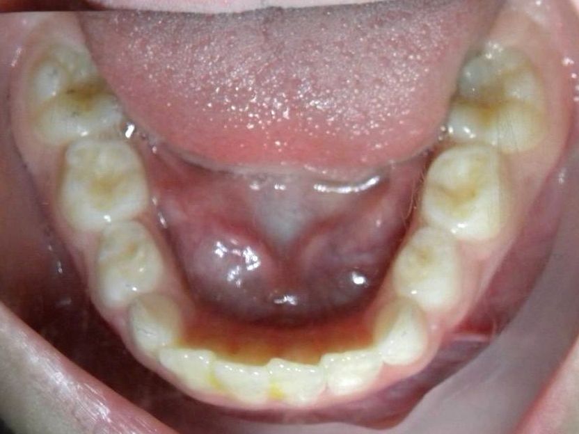 Oclusal Inferior