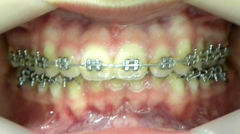 Frontal (Oclusión)