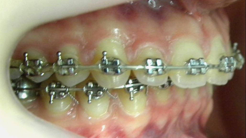 Lateral Derecha
