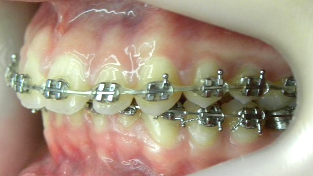 Lateral Izquierda