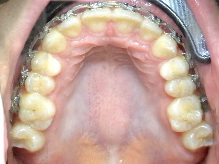 Oclusal Superior