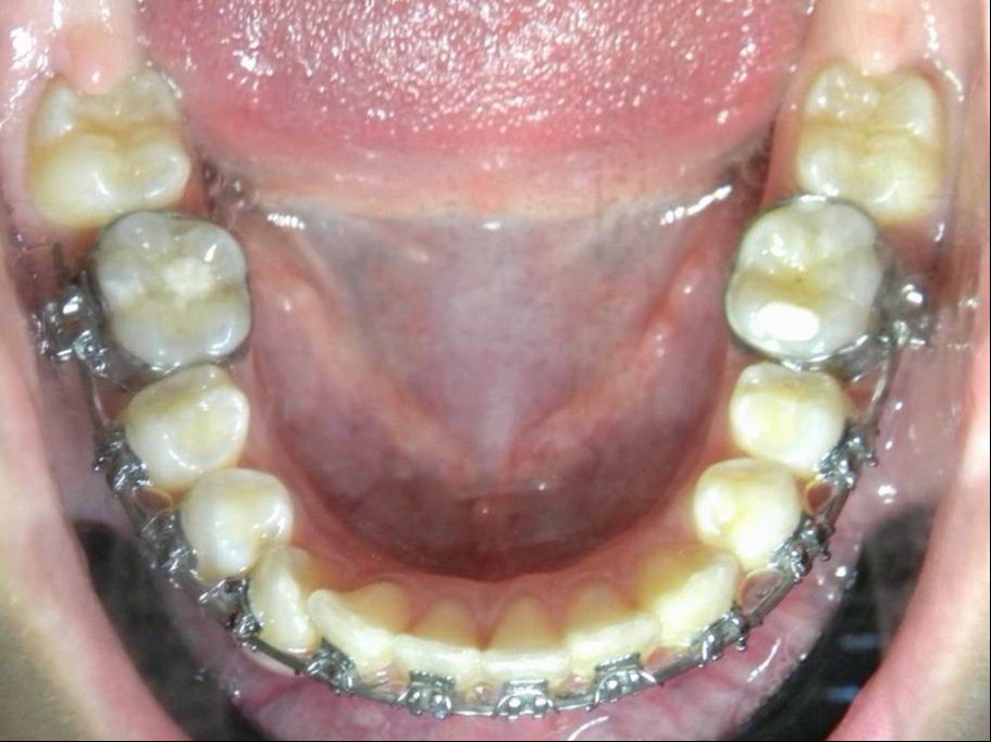 Oclusal Inferior