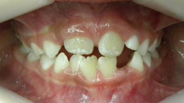 Frontal (Oclusión)