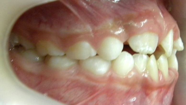 Lateral Derecha