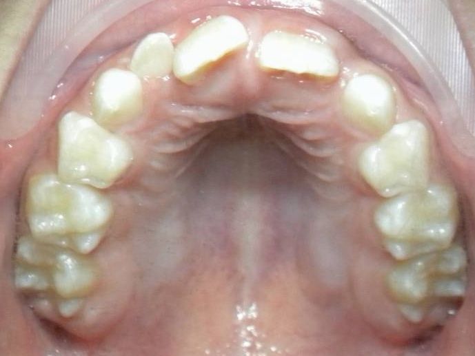 Oclusal Superior